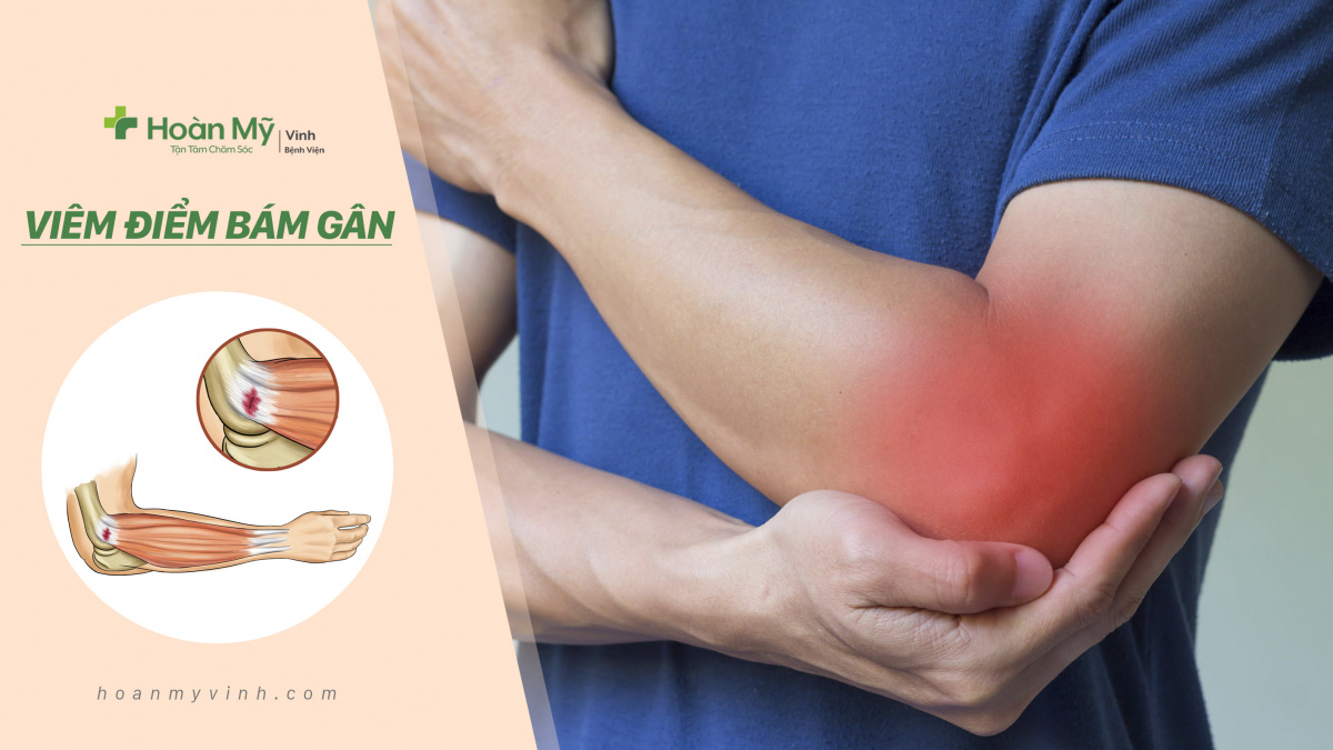 Đau gân cơ là gì? Cách massage giúp giảm đau gân cơ